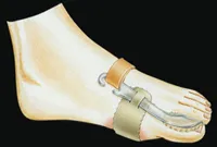 Bunion Night Splint